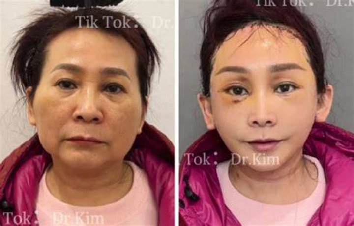 Alyssa Mckay Plastic Surgery Viral On Tiktok: Before And After Photo