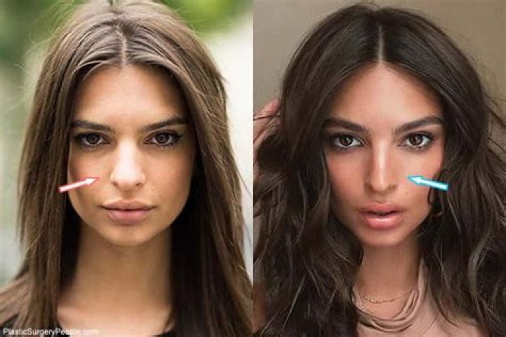 Did Emily Ratajkowski Have Breast Augmentation? Boob Job And Surgery Update