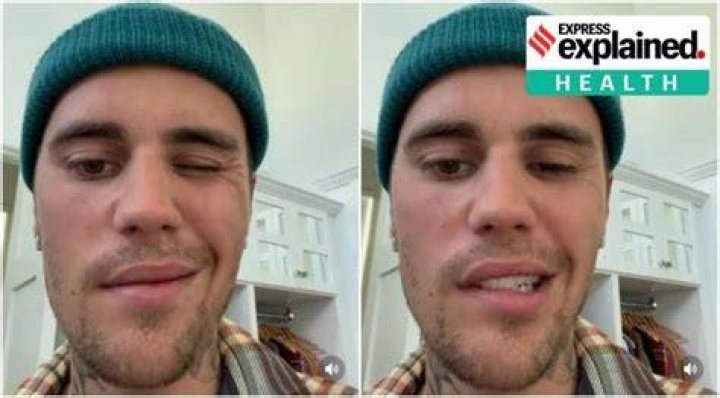 
Is Ramsay Hunt Syndrome Permanent? Justin Bieber Paralyzed Face Illness Explained 