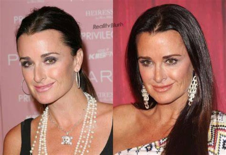 
Kyle Richards’ Botox, Before And After Photos: Has She Done Nose Job And Lip Filler 